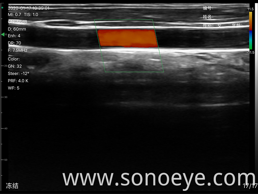 Super Width Linear Ultrasound Scanner for Breast Inspect